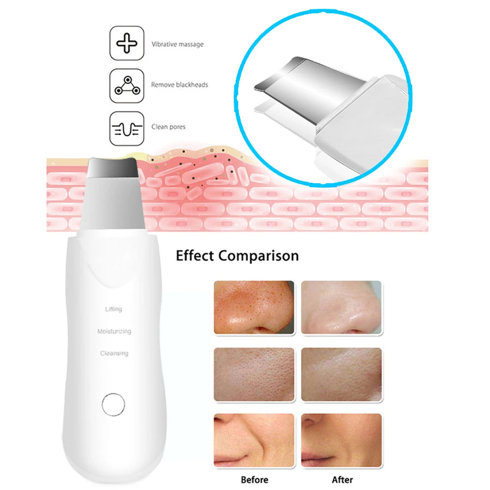 Ultrasonic Facial Scrubber & Pore Cleaner